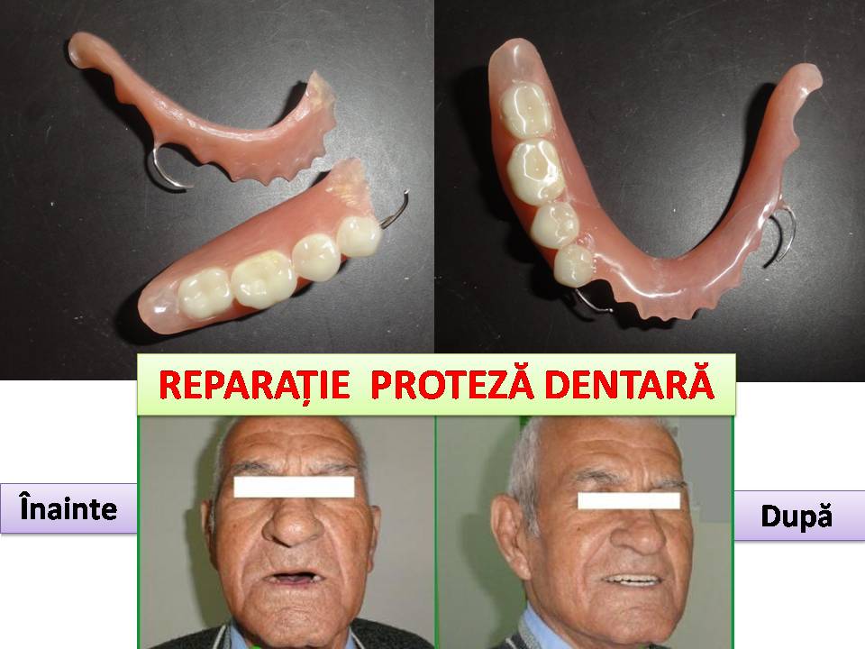 Reparatii proteze dentare urgente Non Stop