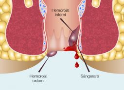 tratament hemoroizi si fisuri anale
