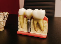 implant dentar