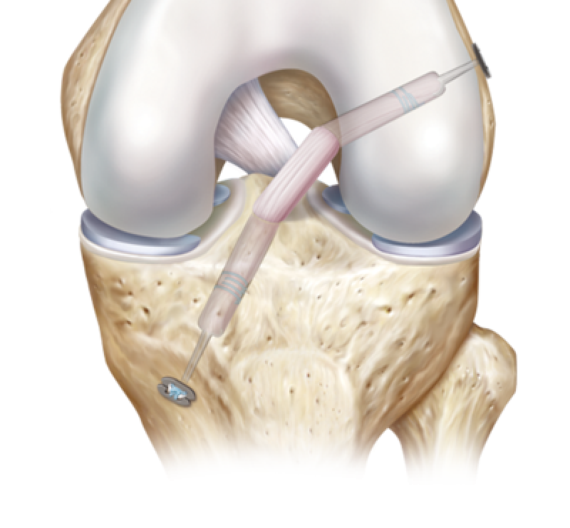 ruptura ligament